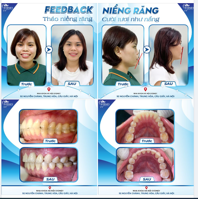THÁO NIỀNG RĂNG - CƯỜI TƯƠI NHƯ NẮNG