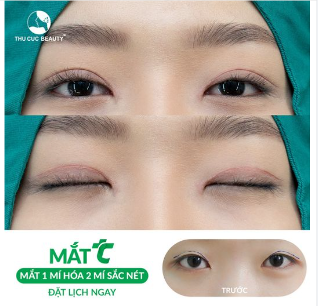 Không còn tự ti vì mắt một mí . Lựa chọn ngay Mắt TC