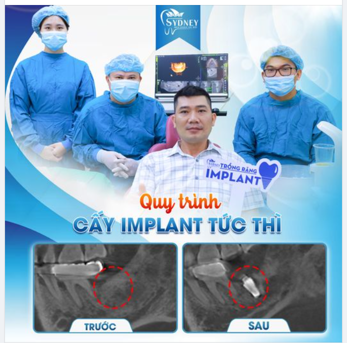 QUY TRÌNH CẤY IMPLANT TỨC THÌ