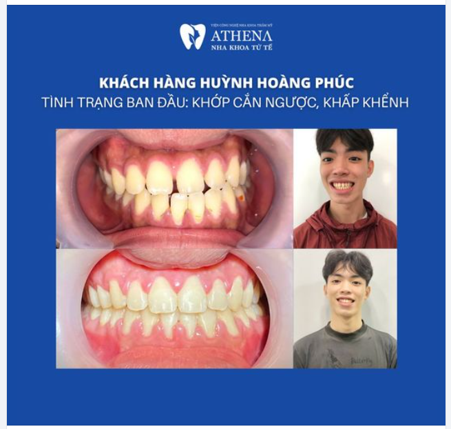 Chúc mừng khách hàng Huỳnh Hoàng Phúc tháo niềng thành công!