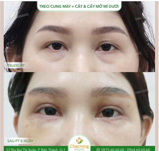 Nàng khách của Charming đã đến thực hiện treo cung mày, cắt và cấy mỡ mí dưới để giải quyết tình trạng mắt nhiều lớp mí lót cũng như phần mỡ thừa bọng mắt dưới nhiều.
