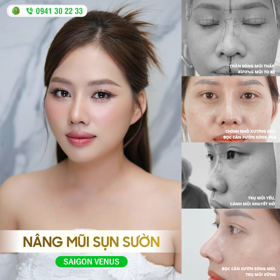 CÔNG NGHỆ SỤN SƯỜN FASCIA CÂN CHỈNH MỌI KHUYẾT ĐIỂM MŨI