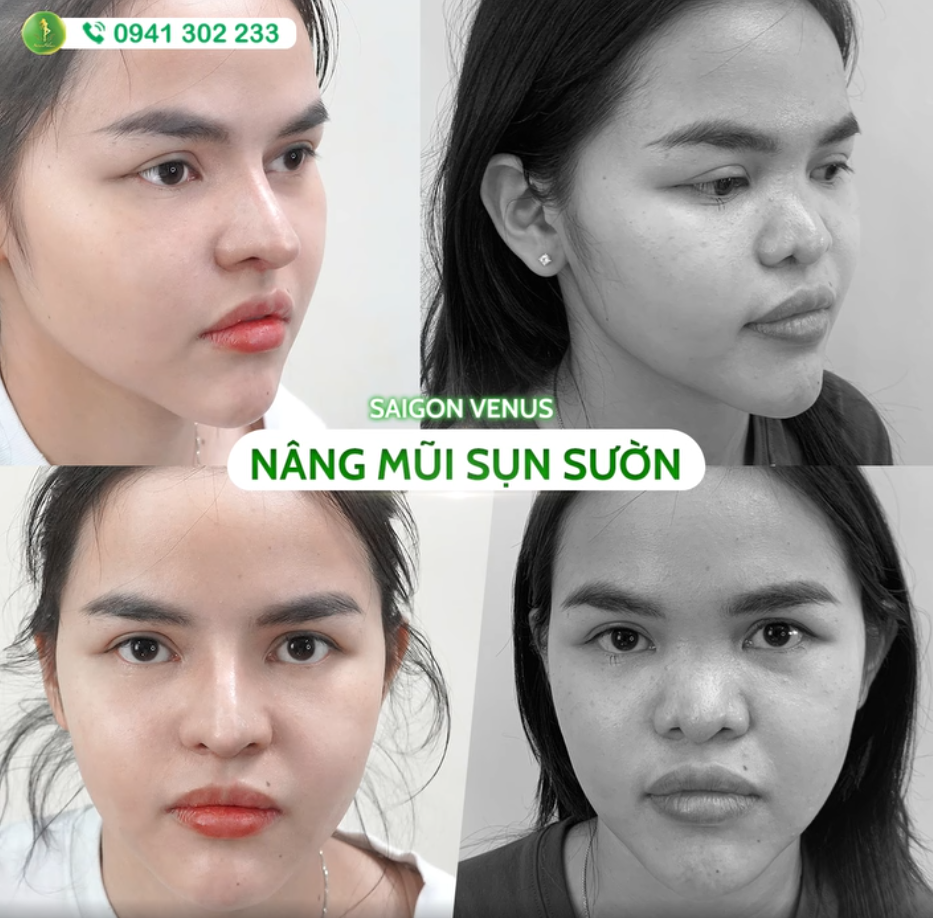 SỰ THAY ĐỔI KHÁC BIỆT KHI BIẾT ĐẾN NÂNG MŨI SỤN SƯỜN TẠI SAIGON VENUS