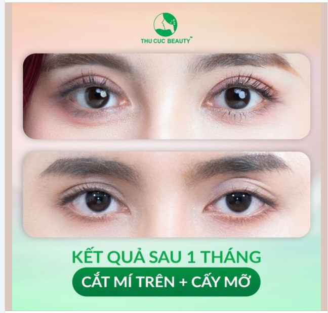 Ngỡ ngàng kết quả Cắt mí trên + Cấy mỡ mắt vượt ngoài mong đợi của KH Tú Anh