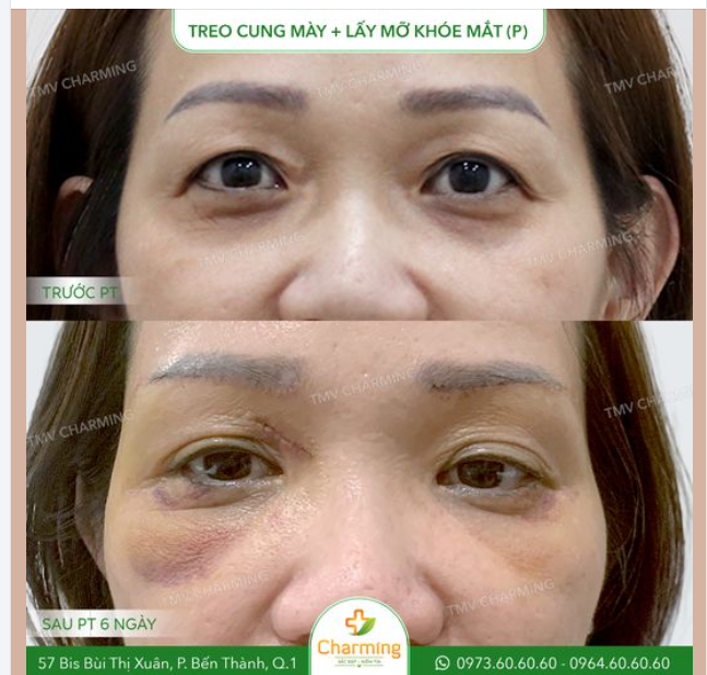 Nàng khách sở hữu phần cung mày sụp và da chùng nhiều, khiến gương mặt thiếu sức sống và trông già dặn hơn so với tuổi.