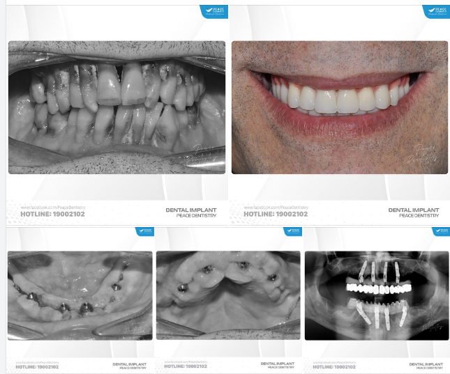 Ca nhổ răng, cấy ghép implant tức thì, phục hình tức thì với chỉ định All-on-4 Implant hai hàm và hoàn thành trong 10 ngày
