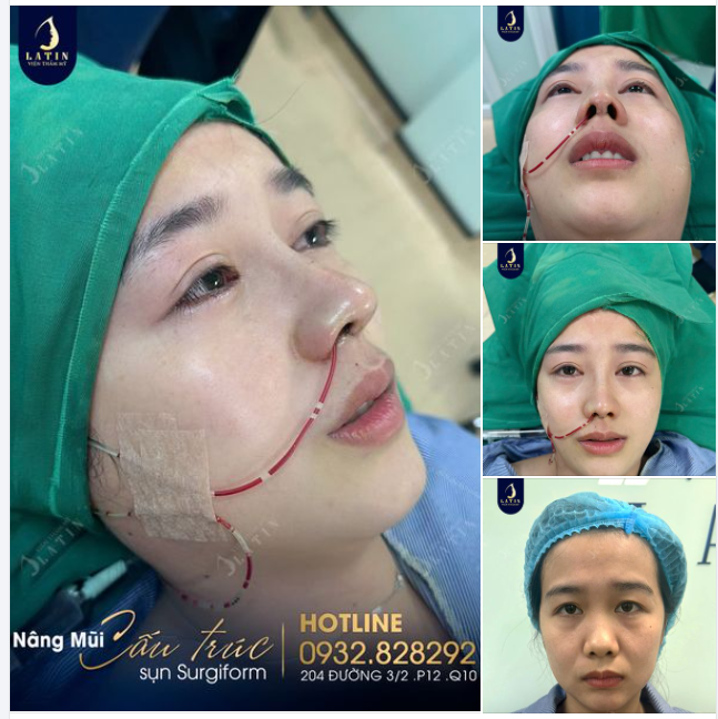 Em gái T.L bất ngờ vì dáng mũi mới. Em gái sở hữu chiếc mũi với sóng mũi rất thấp, gãy ngay phần giữa 2 mắt, đầu mũi ngắn.