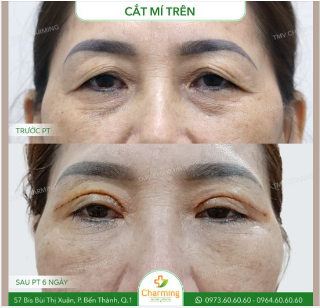 Mắt cô khách có nhiều da chùng và mỡ thừa khiến đôi mắt cô trông buồn bã và che khuất tầm nhìn gây khó khăn trong sinh hoạt.