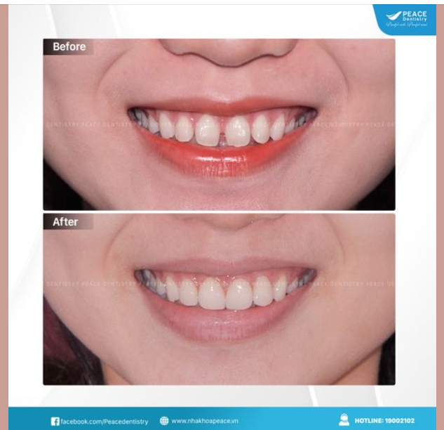 CHỈ VỚI 1 VÀI MẶT DÁN SỨ VENEER NHƯNG VẪN THAY ĐỔI NỤ CƯỜI THẨM MỸ NGOẠN MỤC