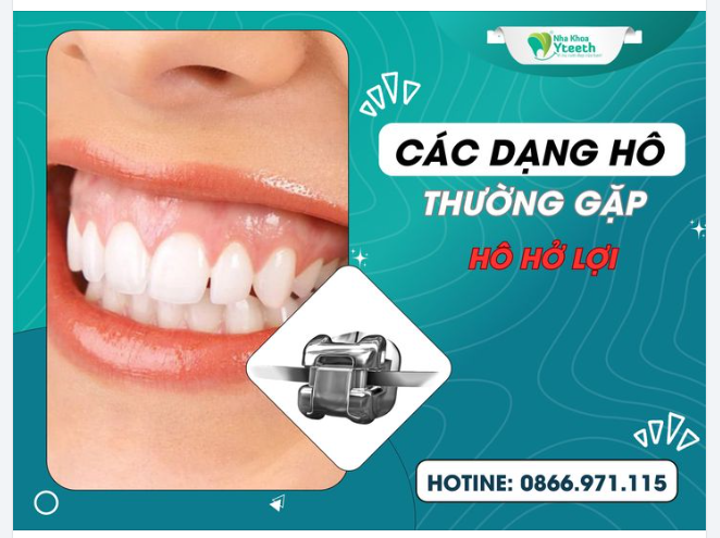 Các dạng hô thường gặp- Răng hô hở lợi