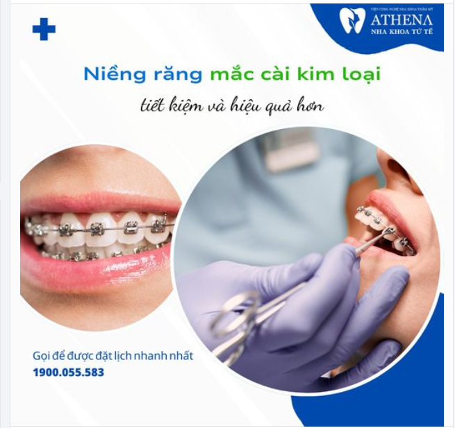 Niềng răng mắc cài kim loại là phương pháp chỉnh nha cổ điển nhưng vẫn được ưa chuộng vì nhiều lý do, từ hiệu quả điều trị đến mức độ tiết kiệm.