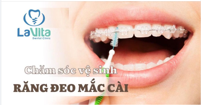 THẾ NÀO LÀ VỆ SINH ĐÚNG CÁCH KHI NIỀNG RĂNG MẮC CÀI?