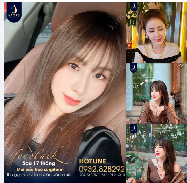 Feedback mũi cấu trúc surgiform 2 năm tuổi