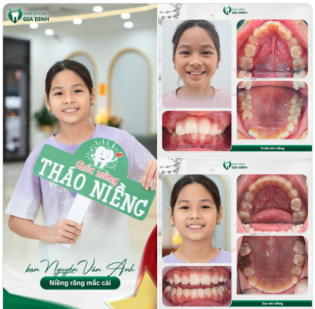 9 THÁNG KIÊN TRÌ NIỀNG RĂNG ĐỔI LẤY THÀNH QUẢ XỨNG ĐÁNG