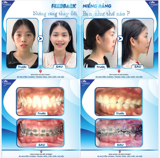NIỀNG RĂNG THAY ĐỔI BẠN NHƯ THẾ NÀO?