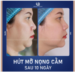 Hút mỡ nọng cằm - Chỉ 20 phút - Xóa sạch mỡ thừa, da chùng, gương mặt thon gọn, đường viền hàm sắc nét, sắc thái gương mặt cũng trở nên nhẹ nhàng, tươi sáng và rạng rỡ.