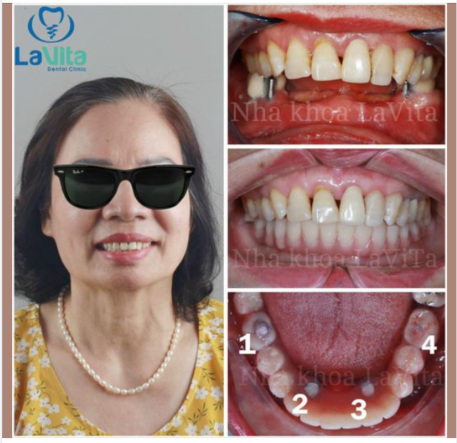 ALL ON 4/ALL ON 6 CÓ ƯU ĐIỂM NHƯ THẾ NÀO ĐỐI VỚI NGƯỜI BỊ MẤT RĂNG TOÀN HÀM?