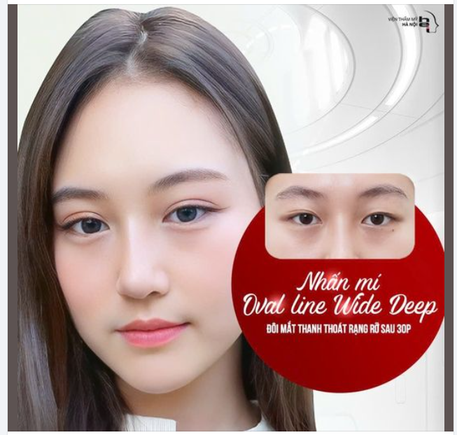 Tại sao nên chọn NHẤN MÍ OVAL LINE WIDE DEEP thay vì cắt mí