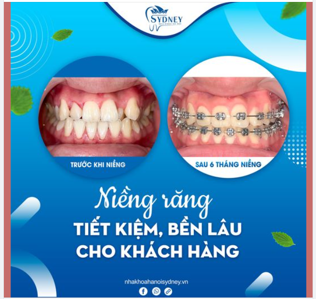 NIỀNG RĂNG TIẾT KIỆM, HIỆU QUẢ DÀI LÂU