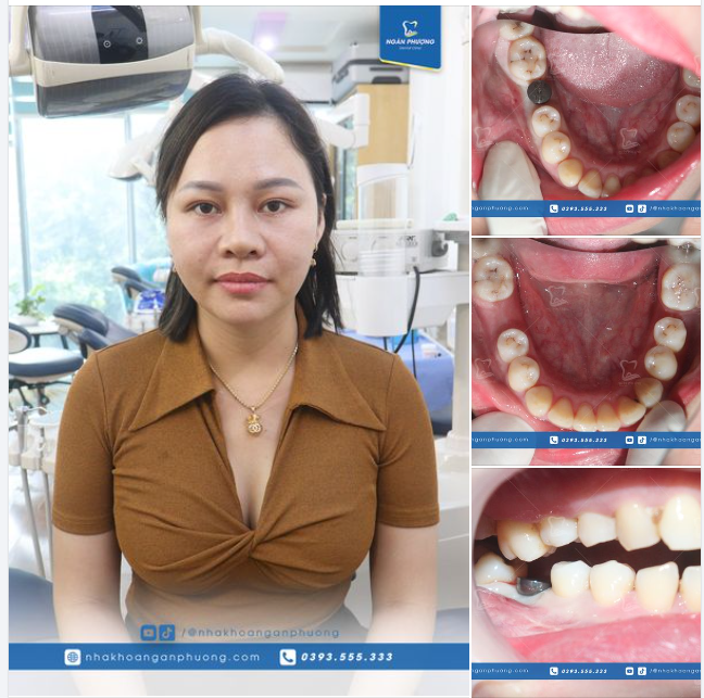 Đã làm việc trở lại và nhẹ nhàng phục hình xong implant răng 6
