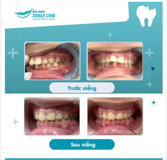 Khắc phục răng hô, con tự tin đến trường! Chúc mừng Nghi đã tháo niềng thành công trước khai giảng năm học mới!
