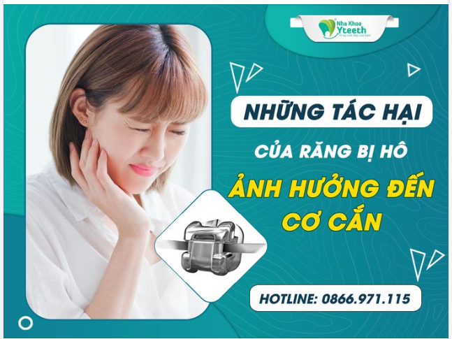 Ảnh hưởng của răng hô đến khớp cắn