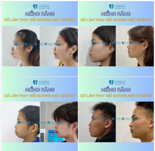 Góc nghiêng trước và sau khi niềng răng thay đổi như thế nào? 