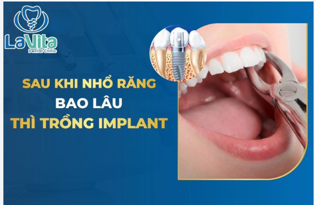 NHỔ RĂNG BAO LÂU THÌ CÓ THỂ TIẾN HÀNH CẤY GHÉP IMPLANT?
