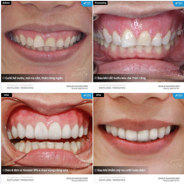 CA LÂM SÀNG CẮT NƯỚU & VENEER VÙNG RĂNG CỬA ĐỂ NÂNG CẤP NỤ CƯỜI, TỰ TIN TOẢ SÁNG