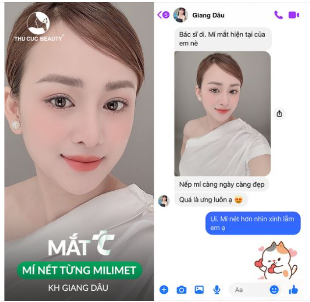 KH Giang Dâu ưng quá chừng với cắt mí TC