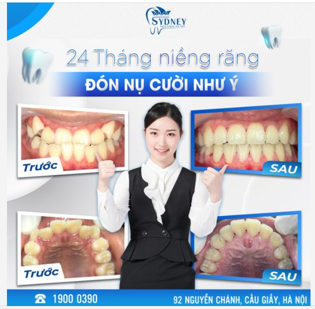 24 THÁNG NIỀNG RĂNG - ĐÓN NỤ CƯỜI NHƯ Ý