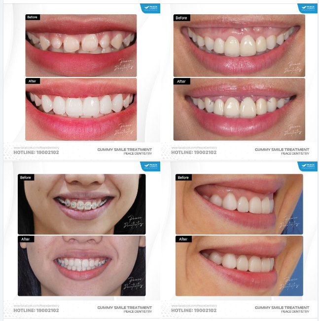 4 PHƯƠNG PHÁP ĐIỀU TRỊ CƯỜI HỞ LỢI DỰA THEO NGUYÊN NHÂN KHỞI PHÁT