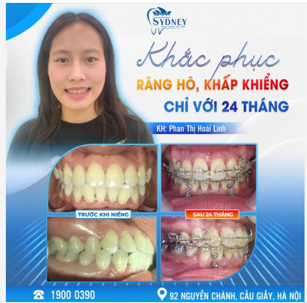 KHẮC PHỤC RĂNG KHẤP KHỂNH CHỈ SAU 24 THÁNG