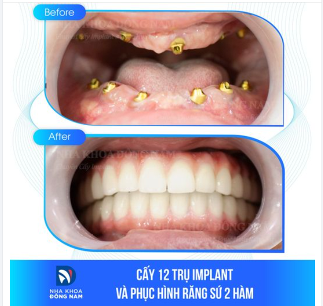 "TÔI ĐÃ SỐNG HẠNH PHÚC HƠN SAU KHI TRỒNG RĂNG IMPLANT"