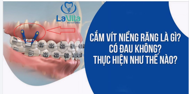 CẮM VÍT NIỀNG RĂNG LÀ GÌ? KHI NÀO CẦN CẮM VÍT NIỀNG RĂNG?