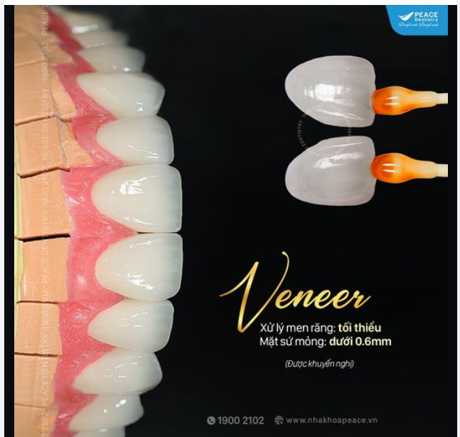 VENEER IPS E.MAX PRESS – PHỤC HÌNH BỀN CHẮC VÀ THẨM MỸ CAO
