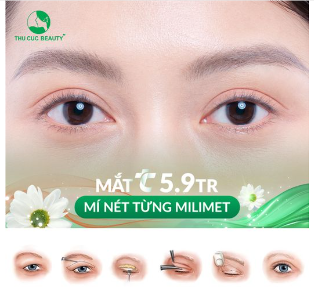 Đừng bỏ qua post này nếu như bạn gặp khuyết điểm về mí sẽ được giải quyết ngay