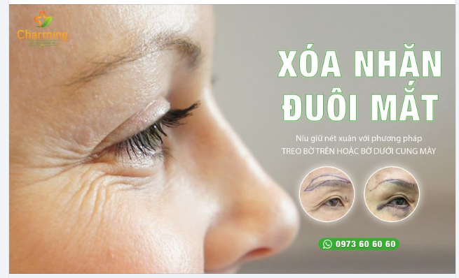 PHƯƠNG PHÁP XÓA NHĂN ĐUÔI MẮT HIỆU QUẢ