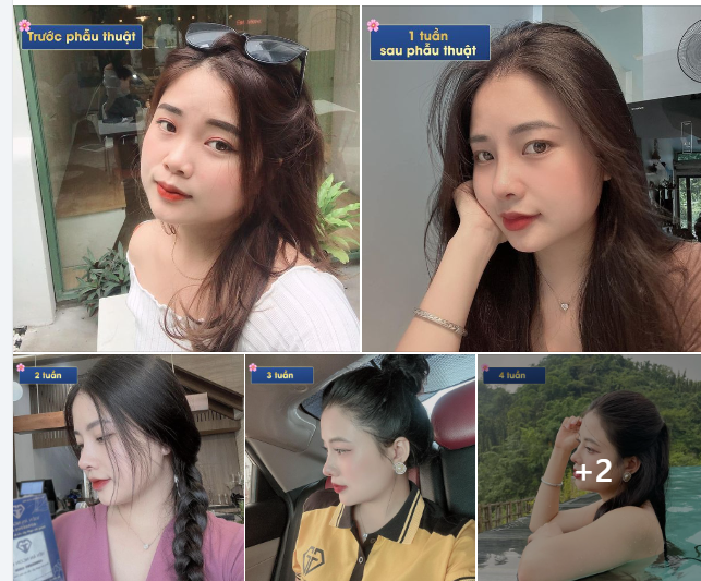 HÀNH TRÌNH TỪ MŨI TO, BÈ THÀNH MŨI CAO TỰ NHIÊN, ĐẸP ƯNG Ý CỦA CHỊ ĐẸP HIỀN ĐỖ (LÀO CAI)