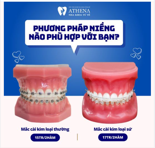 So sánh niềng răng mắc cài kim loại và mắc cài sứ
