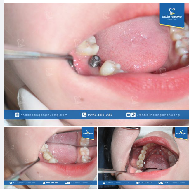 Răng implant khác gì răng thật?  Chân răng implant là trụ hợp kim titan