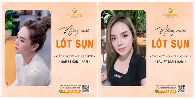Charming vừa nhận được hình feedback từ nàng khách sau khi nâng mũi lót sụn kết hợp cắt xương và thu chóp mũi.