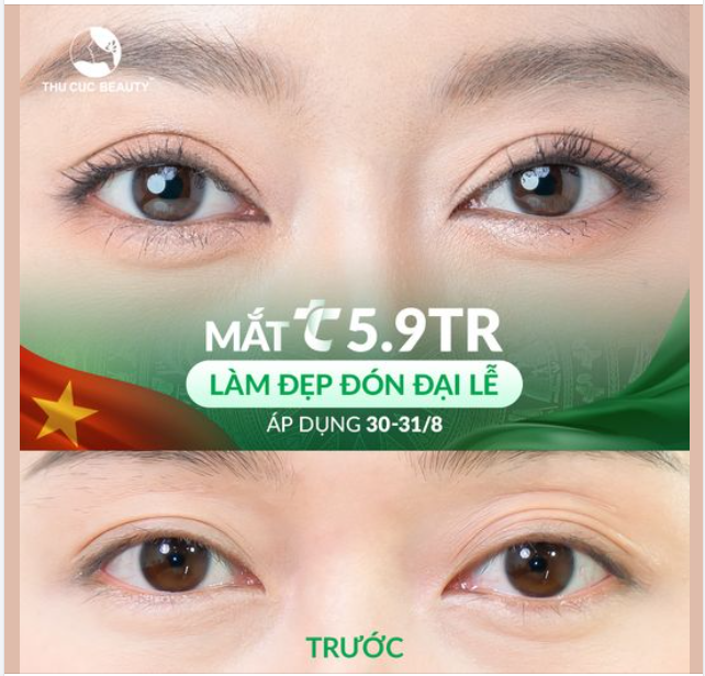 Cắt mí giá tốt nhất năm chỉ có tại Thu cúc duy nhất trong 2 ngày