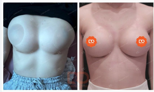 Lết quả nâng ngực đẹp tại DR Điền