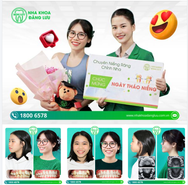 "Mọi người nói có răng khểnh sẽ rất là có duyên nhưng mà đối với em thì nhìn chung thì nó không có xinh cho lắm nên là em quyết định niềng răng ạ"...