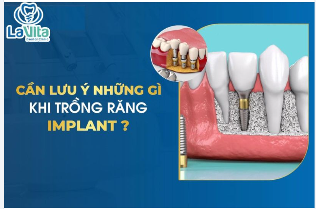 NHỮNG ĐIỀU CẦN LƯU Ý SAU KHI CẤY GHÉP IMPLANT