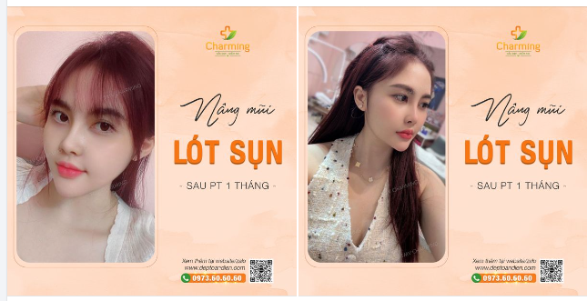 Mũi nàng lót sụn thật xinh. Nàng cười làm cả Charming rộn ràng