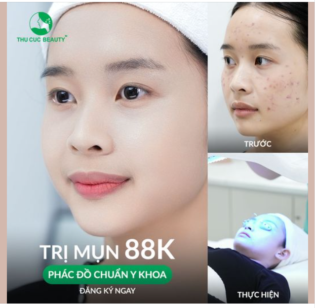 Flex làn da sáng mịn màng , sau 1 liệu trình trị mụn tại Thu Cúc