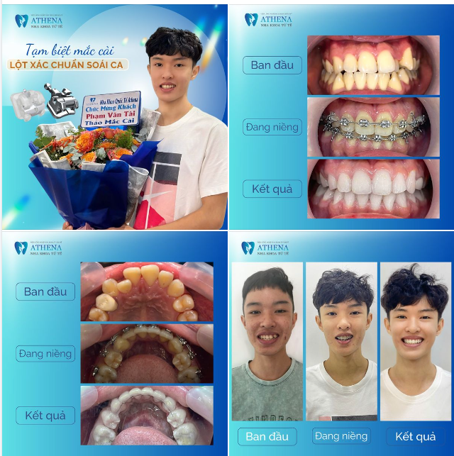 Câu chuyện của bạn Phạm Văn Tài, sinh ngày 15/06/2003, là minh chứng sống động cho sự thay đổi toàn diện khi quyết định niềng răng tại Nha Khoa ATHENA.