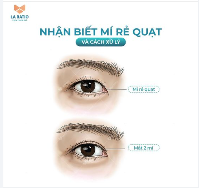 Nhận biết mí rẻ quạt và cách xử lý